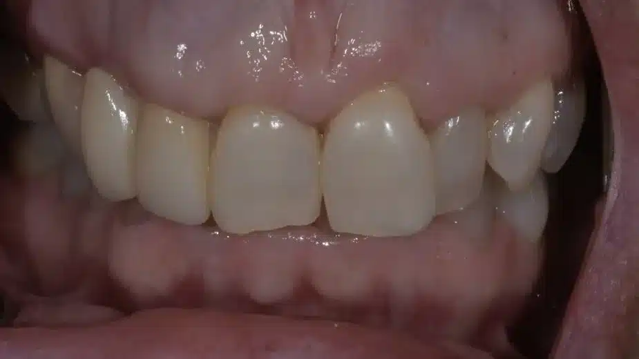 Before